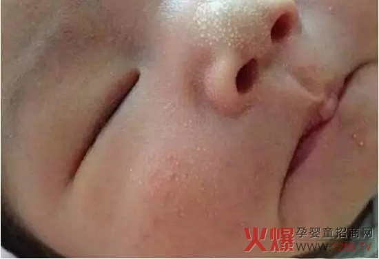 婴儿湿疹.jpg