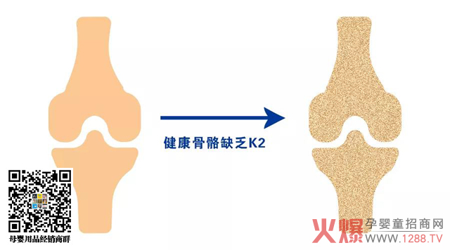 缺乏维生素K2的骨骼.jpg