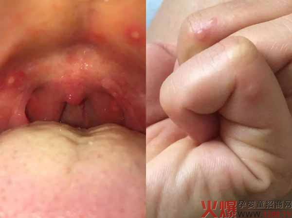 手足口高发季1.jpg
