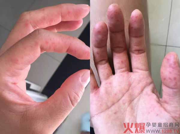 手足口高发季2.jpg