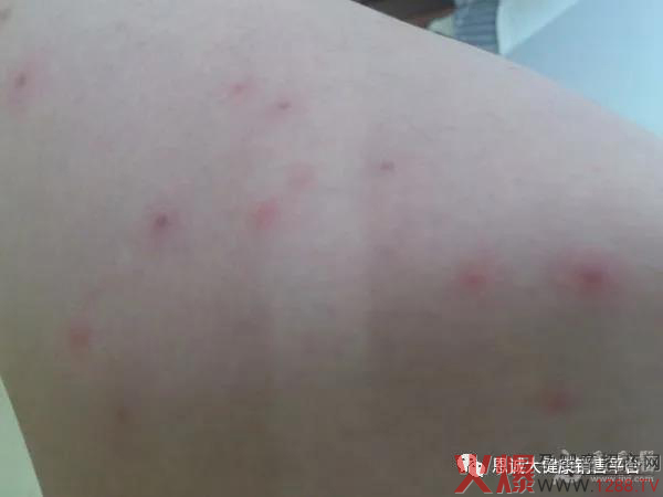 “宝童健”蚊虫叮咬止痒膏3.jpg