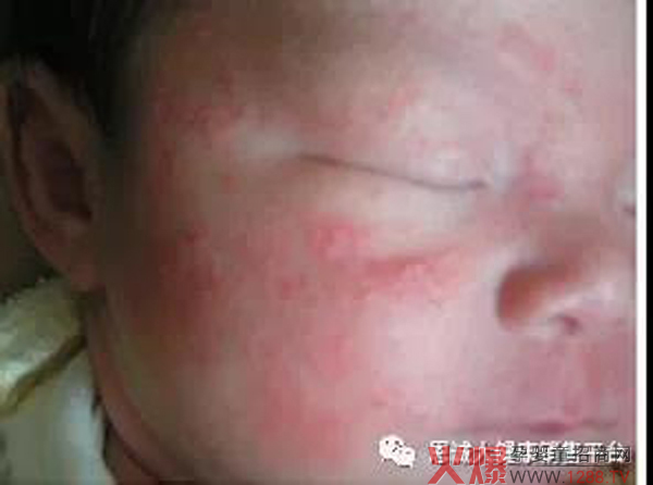 “宝童健”蚊虫叮咬止痒膏5.jpg