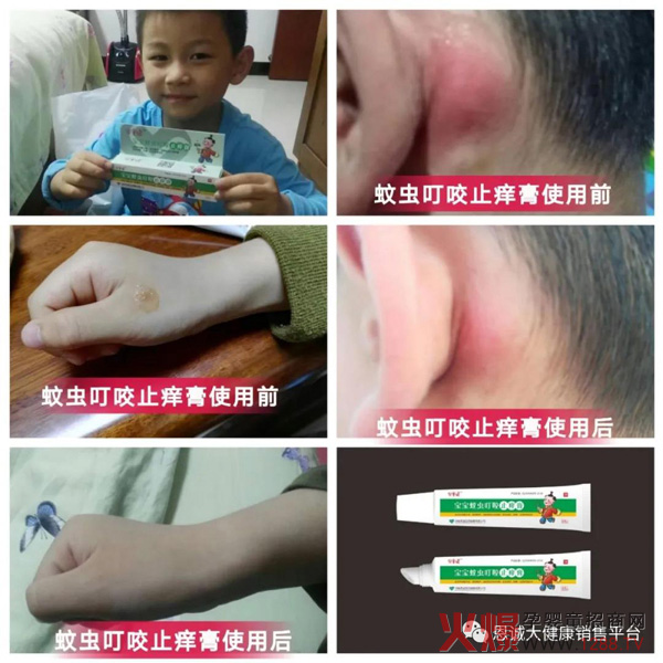 “宝童健”蚊虫叮咬止痒膏8.jpg
